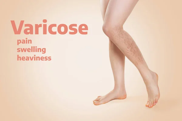 Smooth female legs, with varicose veins on the lower leg. Beige background. The inscription Varicose. The concept of varicose disease.