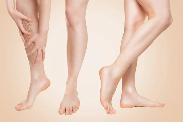 Önce ve sonra. Kadın hastalıklı damarlarla elleri ile bacağını tutuyor ve tedaviden sonra sağlıklı bacakları gösteriyor. Bej arka plan. Varis hastalığı kavramı.