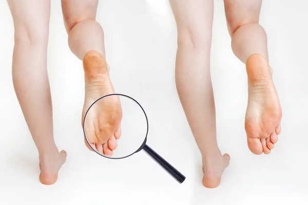 Θηλυκά Πόδια Ξηρό Καλαμπόκι Και Κάλους Λευκό Φόντο Κοντινό Πλάνο — Φωτογραφία Αρχείου