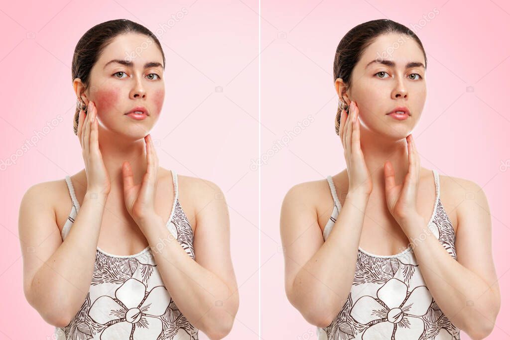 Portrait of a young Caucasian woman showing redness and inflamed blood vessels on her cheeks. Before and after. Pink background. The concept of rosacea and couperose.