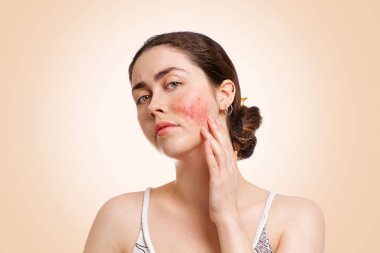 Portrait of a young pretty Caucasian woman who frowns and shows reddened and inflamed cheeks. Beige background. Copy space. The concept of rosacea, healthcare and couperose. clipart