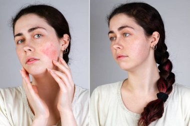 Portrait of a young Caucasian woman showing redness and inflamed blood vessels on her cheeks. Gray background. The concept of rosacea and couperose. Before and after. clipart