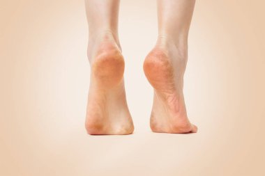 Kirli ve nasırlı ayaklı bir kadın, bej bir arka planda yakın plan. Uzayı kopyala Dikiz aynası. Kozmetoloji, dermatoloji ve sağlık sorunu kavramı.