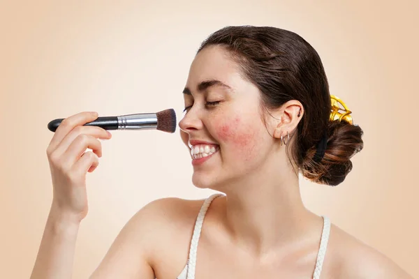 Portrait Young Happy Woman Rosacea Her Face Applying Makeup Brush — Stock Photo, Image