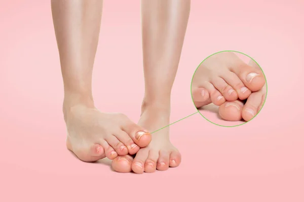 Tırnak Mantarı Hastalığıyla Birbiri Ardına Yerleştirilmiş Kadın Ayakları Haelthy Tırnaklarının — Stok fotoğraf