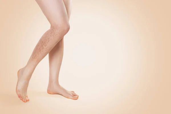 Gambe Femminili Lisce Con Vene Varicose Nella Parte Inferiore Della — Foto Stock