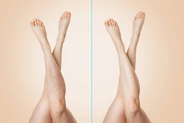 Before and after. Female legs raised up and crossed with each other, with and without varicose veins. Beige background. The concept of varicose disease.