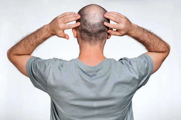 Homem Segura Mãos Sobre Cabeça Careca Demonstrando Alopecia Focal Visão — Fotografia de Stock