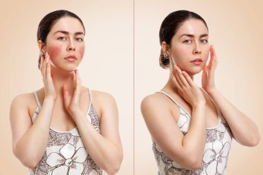 Yanaklarında kızarıklık ve iltihaplı kan damarları gösteren beyaz bir kadının portresi. Bej arka plan. Rosacea kavramı, öncesi ve sonrası..