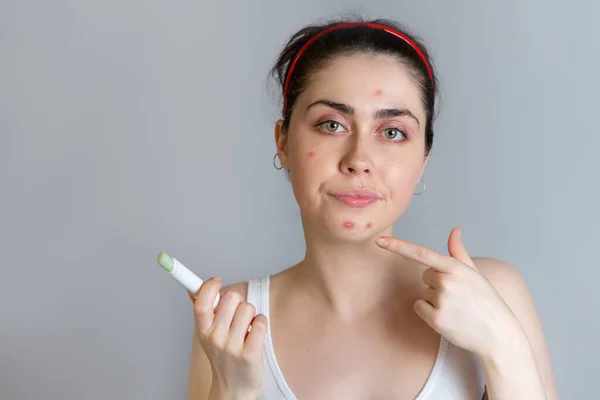 Disgruntled Young Woman Points Acne Her Chin Concept Acne Growing — Stock Photo, Image