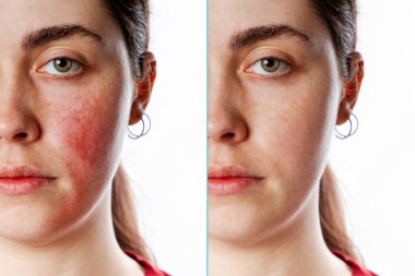 A close-up portrait of a young Caucasian woman showing redness and inflamed blood vessels on her cheeks. Isolate. Before and after. The concept of rosacea. clipart