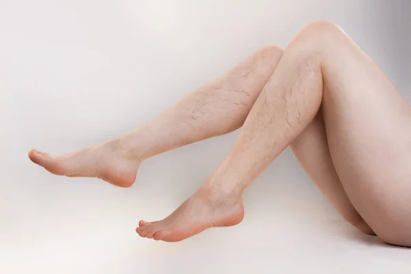 Concetto Malattia Varicosa Cosmetologia Donna Siede Giocosamente Spargendo Gambe Snelle — Foto Stock