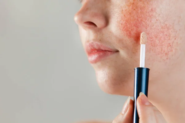 Medicine Cosmetology Female Cheek Rosacea Close Cosmetic Foundation Brush Skin — Stock Photo, Image