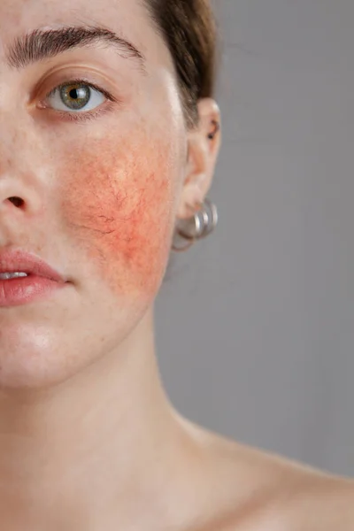 Kozmetoloji ve rosacea. Yanaklarında rosacea olan genç bir kadının portresi..