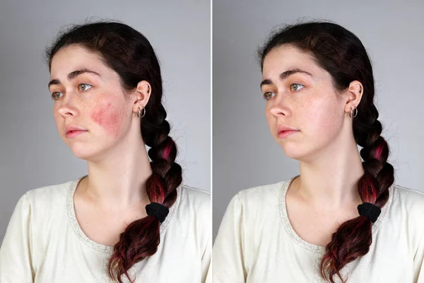 Portrait Young Caucasian Woman Showing Redness Inflamed Blood Vessels Her — Stock Photo, Image