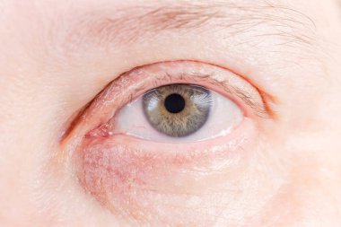 Küçük miktarlarda sarı renkli gri iris ve sklera üzerinde kan damarları olan insan gözü, seçici odak noktasında yakın plan.