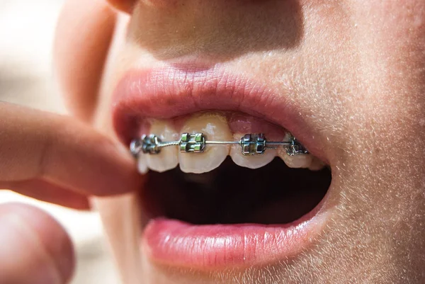 Ajar Boca Com Aparelho Dentário Metal Dental Para Dentes — Fotografia de Stock