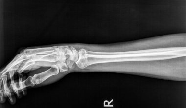 Fractures to the radius born with displacement of the right woman's arm we see on an X-ray clipart