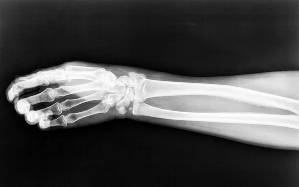 Fractures to the radius born with displacement of the right woman\'s arm we see on an X-ray