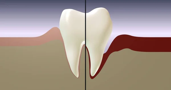 Periodontal hastalık. Dişeti iltihabı. Kemik dokusu imha. Kesit çizimi. 