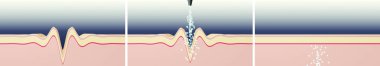 Wrinkle smoothing illustration. Cosmetic procedure. Skin cross-section illustration. Horizontal orientation.