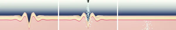 Wrinkle smoothing illustration. Cosmetic procedure. Skin cross-section illustration. Horizontal orientation.
