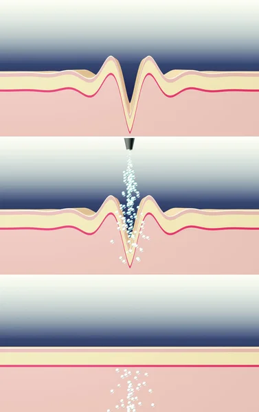 Wrinkle smoothing illustration. Cosmetic procedure. Skin cross-section illustration. Vertical orientation.