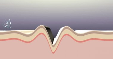 Wrinkle correction treatment procedure. Animation of the skin care anti-aging products action. Cross-section of the derm. 