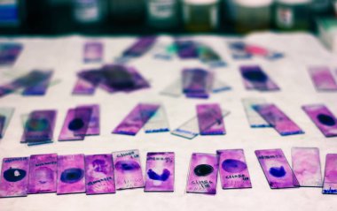 stained glass slides of peripheral blood smear with violet leishman giemsa stain in hematology pathology laboratory clipart