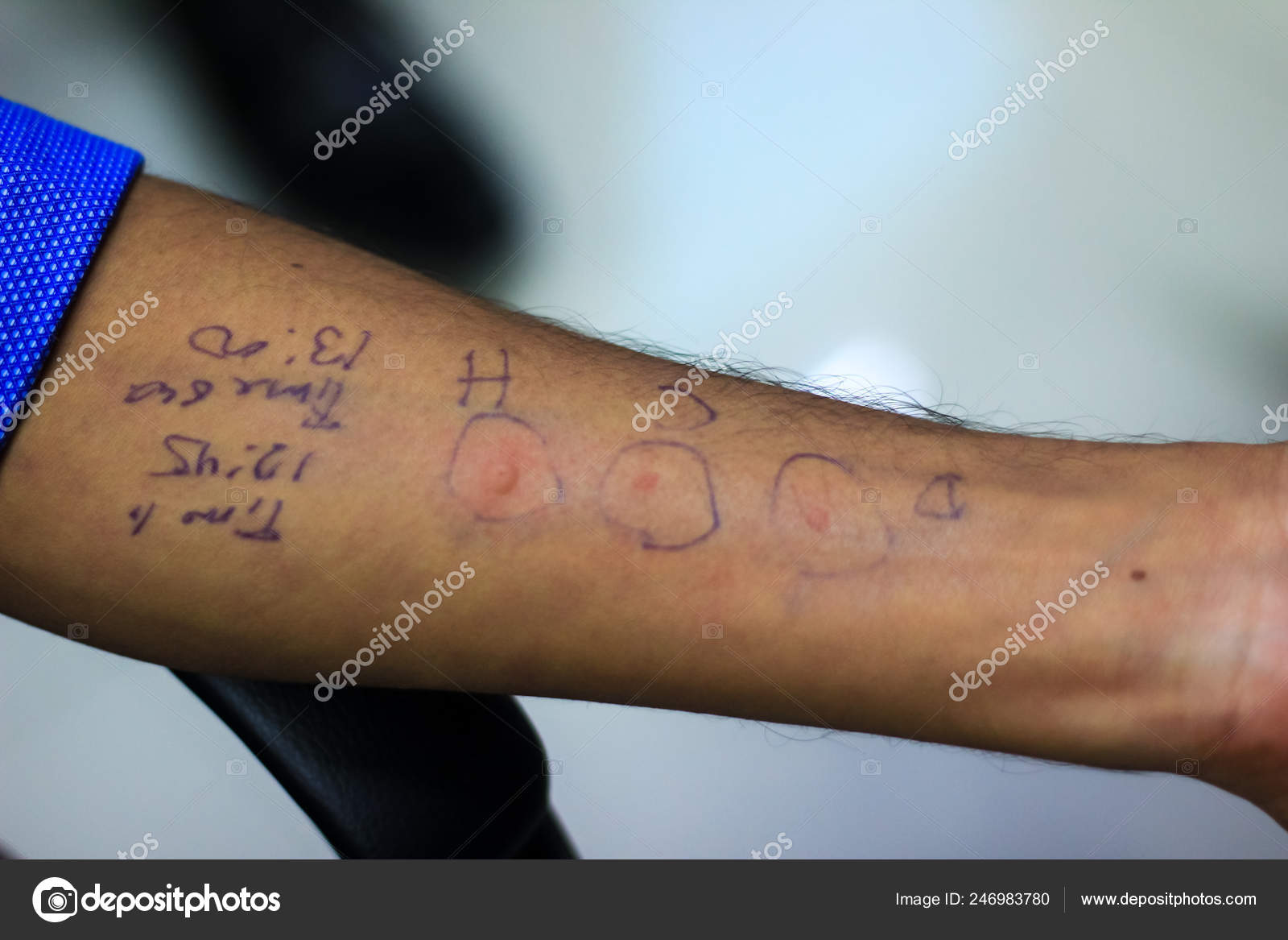 Skin Allergy Test Preparation Doctor Patient Hand Showing Allergic Hypersensitivity