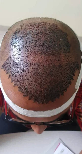 Ansicht der Kopfhaut mit follikulärer Haartransplantation, — Stockfoto