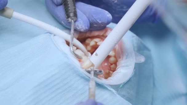 Borra Tänder Och Suga Saliv Med Ejektor Ung Kvinna Tandkliniken — Stockvideo