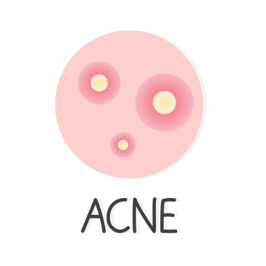 sivilce, sivilce kavramı - vektör çizimi