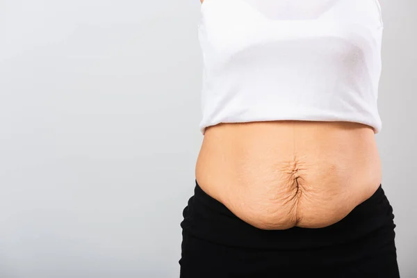 Aproape Femeia Mamă Asiatică Care Prezintă Pielea Abdomenului Inferior Slăbit — Fotografie, imagine de stoc