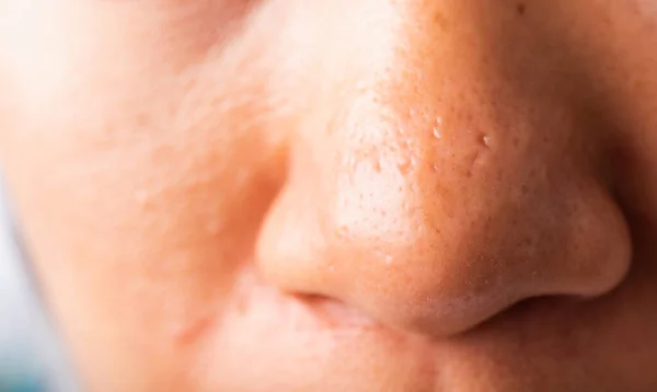 Closeup Asian Young Woman Large Pores Have Freckles Cheek Oily — Stock Photo, Image