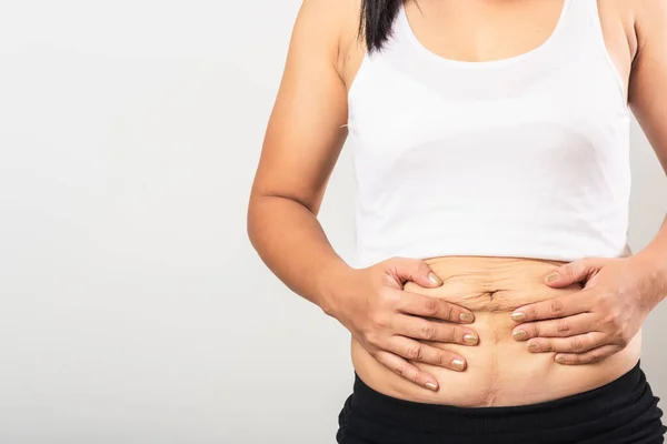 Close Mulher Mãe Asiática Mostrando Estrias Soltas Abdômen Inferior Pele — Fotografia de Stock