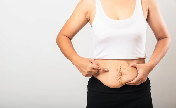 Gros Plan Asiatique Mère Femme Pointant Vergeture Lâche Bas Ventre — Photo