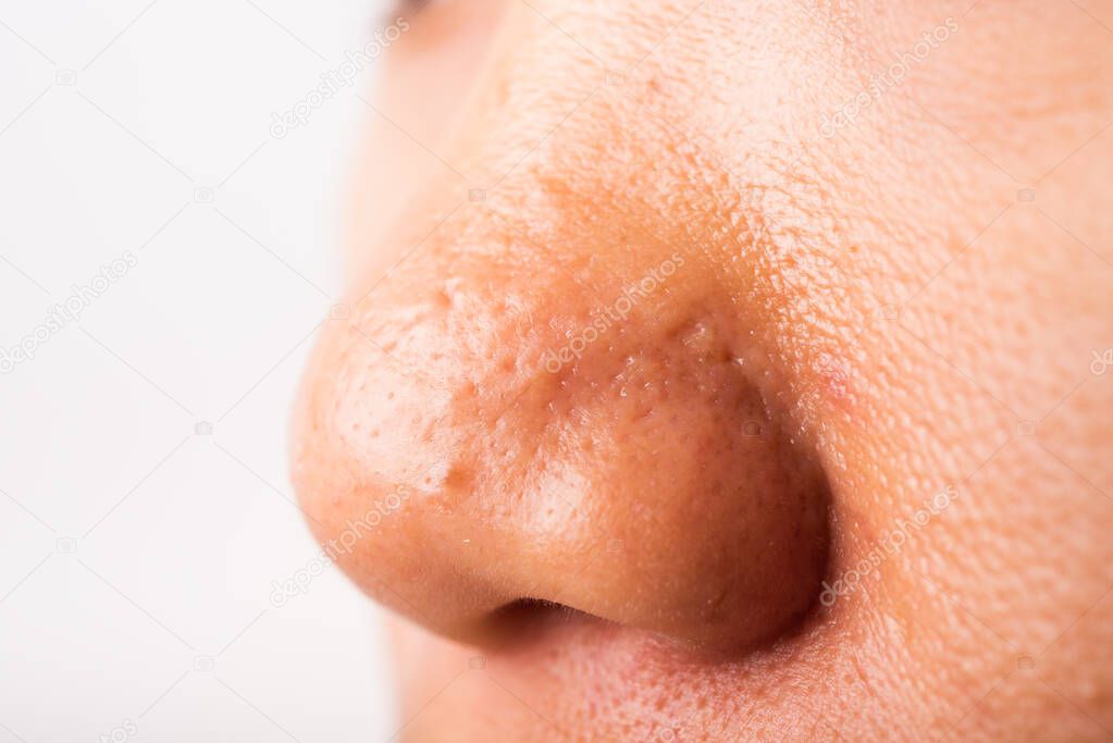 Closeup Asian young woman large pores have freckles cheek oily, acne pimple on nose, studio shot isolated on white background, Healthcare beauty skin face problem concept
