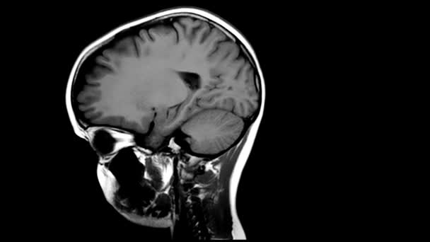 Resonancia que cerebral es magnetica
