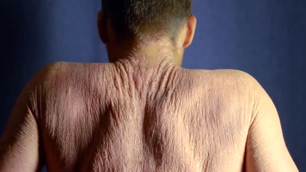 pacient projevuje svou kůži zad zahrnuty psoriáza v temné místnosti, pohybující se ramena
