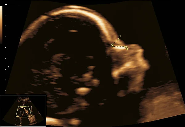 Новонароджена дитина в ультразвуку зображення — стокове фото