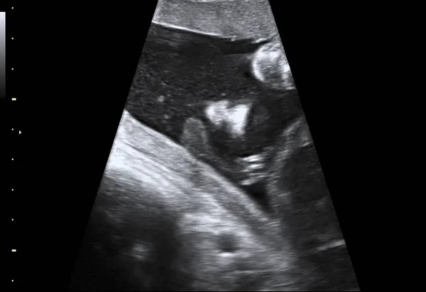 Pasgeboren baby in beeld echografie — Stockfoto