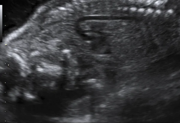 Bebé recién nacido en ecografía de imagen — Foto de Stock