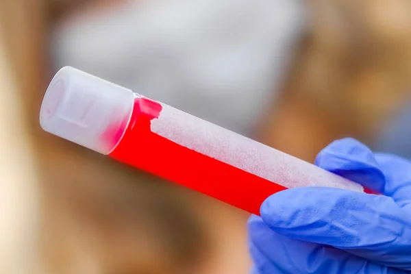 Nas Mãos Tubo Teste Com Sangue Para Análise Vírus Covid — Fotografia de Stock