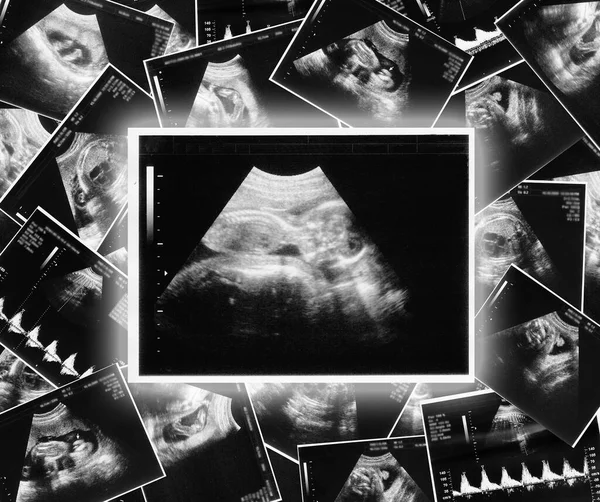 Echografie Foto Van Een Kind Baby — Stockfoto