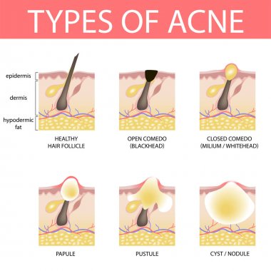 Medical vector illustration of different types of acne on human  clipart