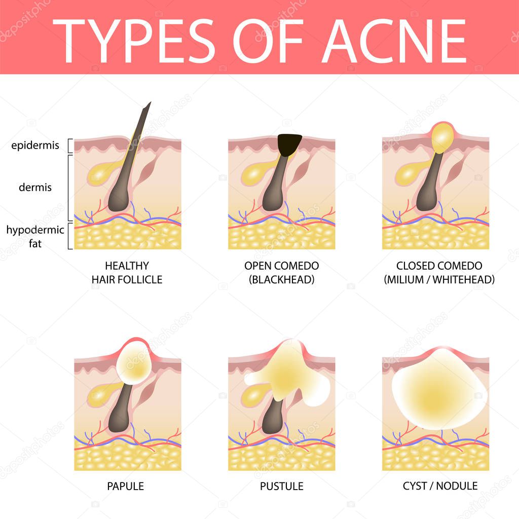 Medical vector illustration of different types of acne on human 
