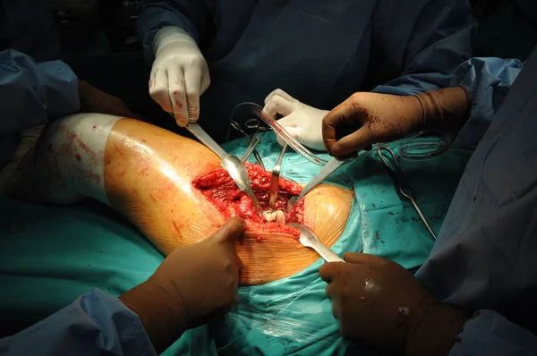 Heupprothese Operatie Het Ziekenhuis — Stockfoto