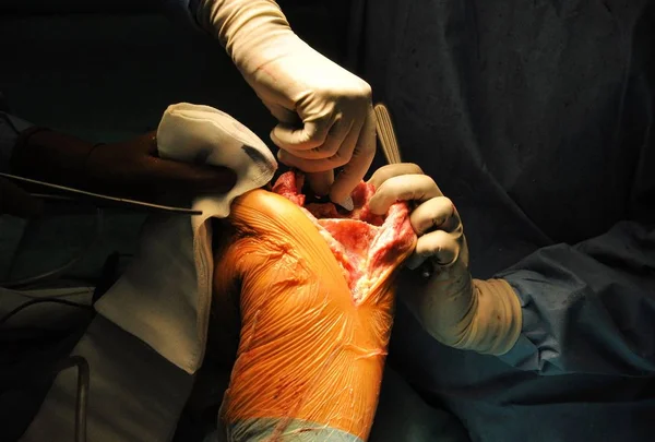 Prothese Van Knie Ziekenhuis Operatie — Stockfoto