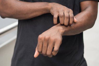adam kaşıntı deri acı; derisi ile Anti, döküntü, mantar hastalığı, tinea sorun tırmalamak hasta Afrika adam; Sağlık, Cilt Bakımı, Dermatoloji kavramı; Yetişkin Afrika adam, siyah adam modu